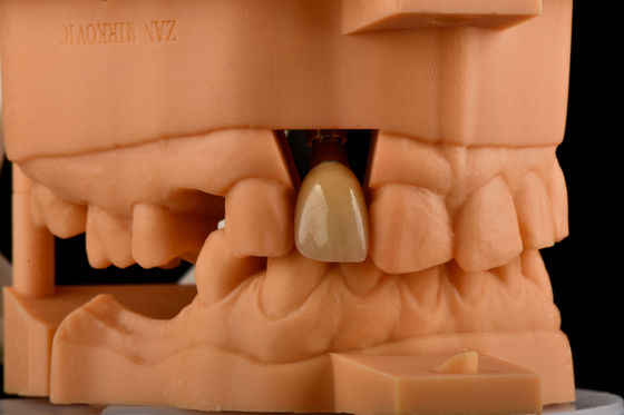 Αγορά Εσωτερική έξαρση 3,0 mm Βαθμός 1,5 mm Στρώση Μονή Τιτανίου Εμφυτοπλαστικό σε απευθείας σύνδεση κατασκευή