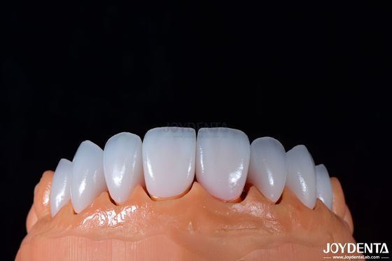 Αγορά 0.3-0.5mm πάχος Emax πορσελάνη φινίρισμα για υψηλή λάμψη καλλυντική οδοντιατρική σε απευθείας σύνδεση κατασκευή