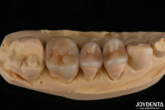 Αγορά Φυσική εμφάνιση Emax Inlay Onlay Μακροχρόνια οδοντική αποκατάσταση 0,5 mm 1 mm 1,5 mm πάχος σε απευθείας σύνδεση κατασκευή