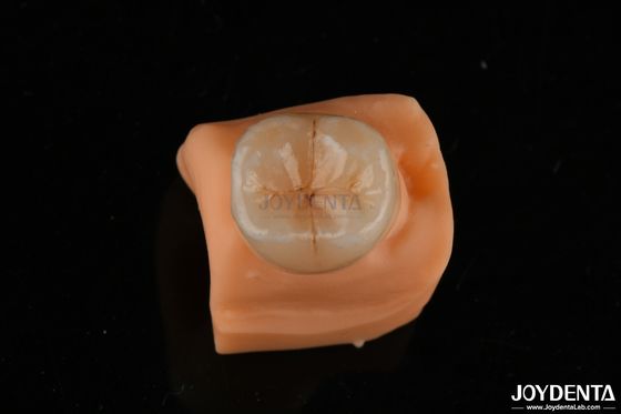 Αγορά 0.5mm Ανθεκτικό σε λεκέ Emax Inlay Onlay Ακριβής προσαρμογή για οδοντικές αποκαταστάσεις σε απευθείας σύνδεση κατασκευή