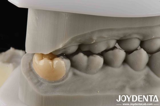 Αγορά Υψηλή αντοχή Emax Καλή διαφάνεια Emax Inlay Onlay για διαφανή απόδοση σε απευθείας σύνδεση κατασκευή