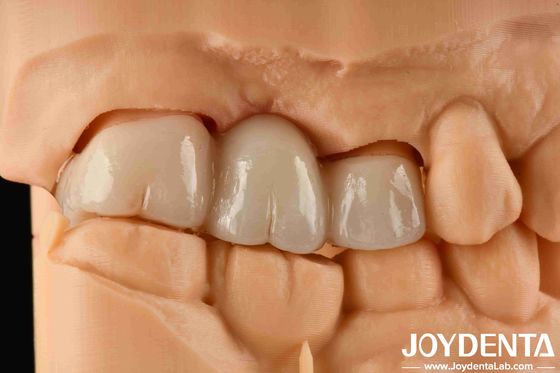 Αγορά Εμπειρία Χρώμα ρεαλιστικό πλήρες ζιρκόνιο με υψηλή αντοχή στη χρωστική και την ελαστική αντοχή 1000 MPa σε απευθείας σύνδεση κατασκευή