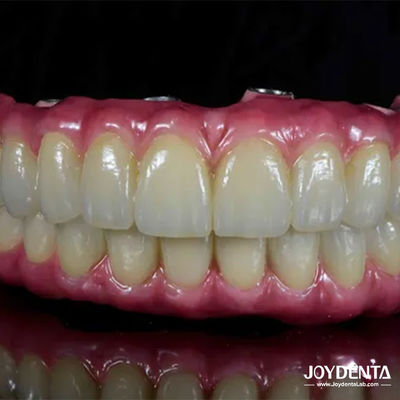 Αγορά Ελαφριά οδοντική γέφυρα από τιτάνιο Malong Hybrid άνετη για την οδοντική αποκατάσταση σε απευθείας σύνδεση κατασκευή