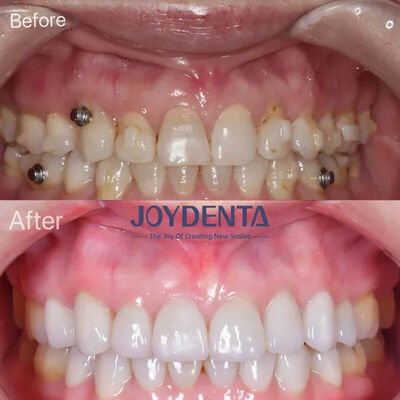 Αγορά Οδοντιατρικές φινέρες για τα χαμένα δόντια. σε απευθείας σύνδεση κατασκευή