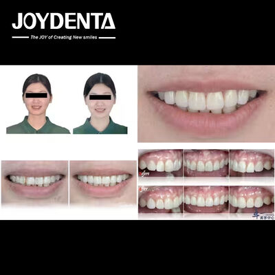 Αγορά Δημοφιλή προϊόντα της Joydentalab: Προσομοιωμένες αισθητικές όψεις σε απευθείας σύνδεση κατασκευή