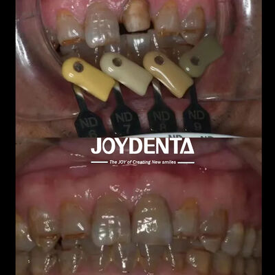 Αγορά Διαφανείς στεφάνες από ζιρκόνια Πολυεπίπεδη τεχνολογία κλίσης σε απευθείας σύνδεση κατασκευή