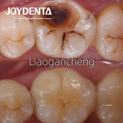 Αγορά Πορσελάνη οδοντιατρική επανένταξη για ενήλικες και παιδιά Εξαιρετική απόδοση σε απευθείας σύνδεση κατασκευή