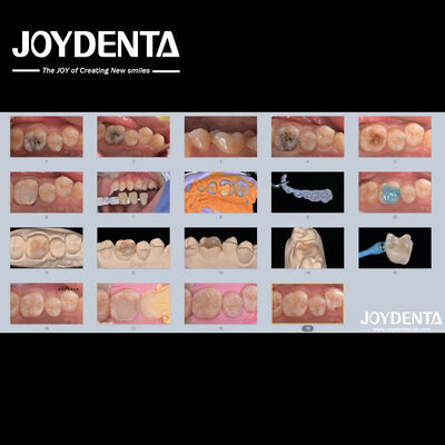 Αγορά Ενήλικες Παιδιά Πορσελάνη Κηραμική Χονδρική Εμφάνιση Επανορθωτικό για Κατεστραμμένα Δόντια σε απευθείας σύνδεση κατασκευή