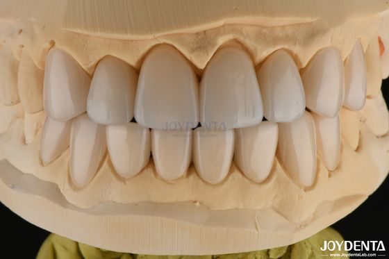 0.3-0.5mm παχύ Feldspathic πορσελάνη Φανίρα υψηλή αντοχή σε κατάγματα αναβαθμίσει το χαμόγελό σας