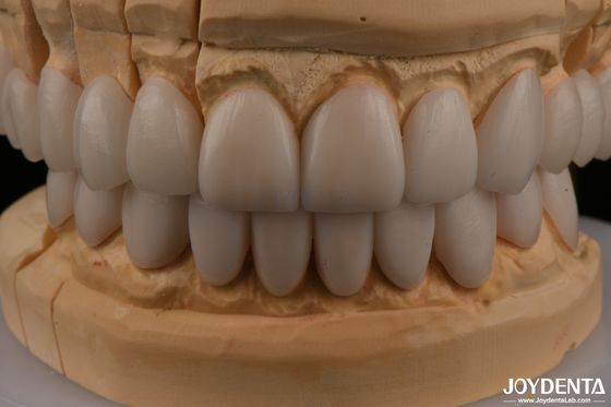 0.3mm πάχος Ips Emax Φανέρες Κεραμικές Φανέρες Προσωρινές και οπίσθιες αποκαταστάσεις