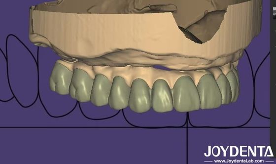 Προσωπικό σχεδιασμό Ψηφιακή διάγνωση Wax Up Lab Λογισμικό