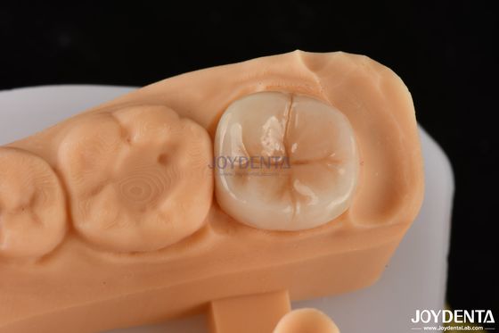 0.5mm-2mm Precise Fit Emax Dental Inlay Onlay για αξιόπιστη αποκατάσταση δοντιών