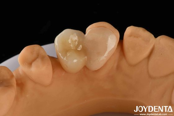 Emax Maryland Veneer Clinical Bonding Adhesion για την αντιστοίχιση χρώματος στη θεραπεία των δοντιών