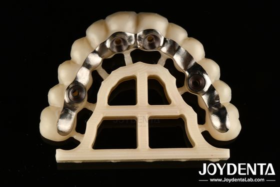 Ασημένιο φινίρισμα Custom Abutments και Bars Precise Fit Screw Retained ή Τσιμέντο Retained