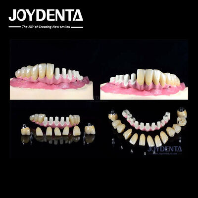 Πολλαπλά ενδοστετικά οδοντικά εμφυτεύματα Εσωτερική σύνδεση για πλήρη αποκατάσταση της αψίδας