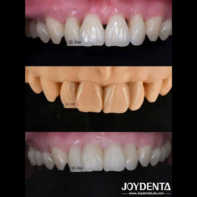 Οι Φανίρες Γκαραμπούλης Η τέλεια λύση για τις φυσικές διαφανείς οδοντικές φανίρες