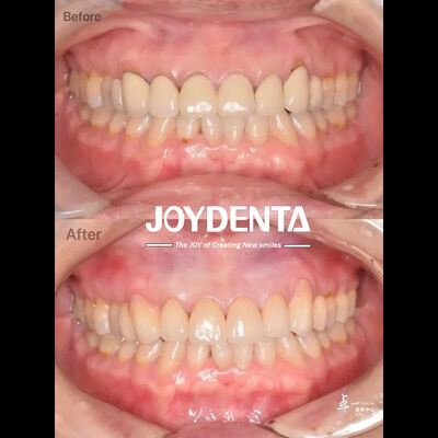 Οδοντιατρική Ζιρκόνια για ασφαλή στοματικό ιστό και συμβατότητα CAD / CAM