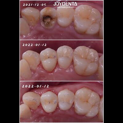 Ακριβής Τροφή Δοντιατρικής Πορσελάνης Εμφυτοποίηση Κατεστραμμένων Δοντιών Αποκατάσταση